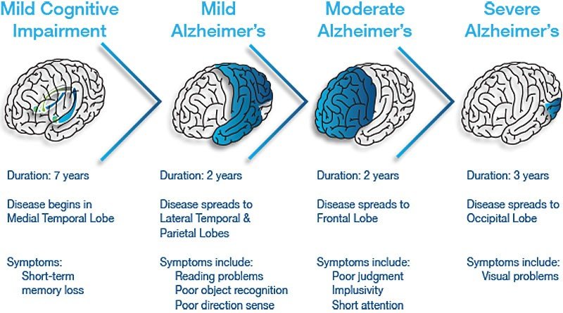 10 Signs of Early Onset Alzheimers