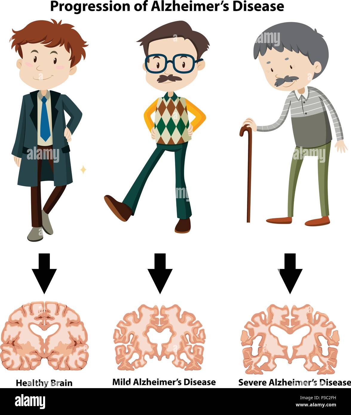 A Progression of Alzheimer