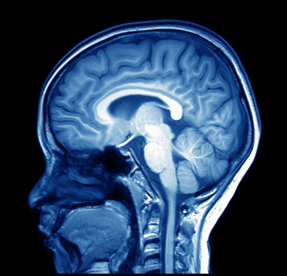 Advanced MRI brain scan analysis may help predict stroke ...