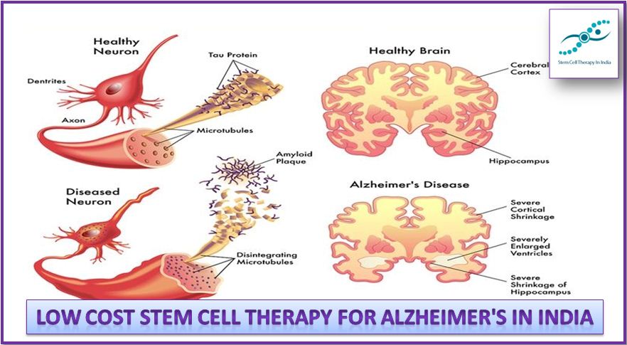 Affordable and Low Cost Benefits Stem Cell Therapy For Alzheimer