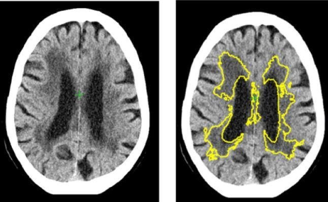AI detects stroke, dementia from brain scans