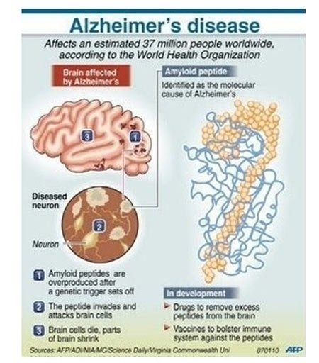 Alzheimer Stem Cell Therapy