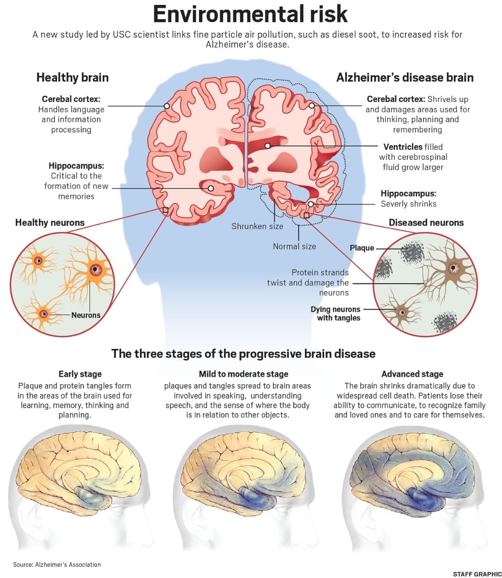 Alzheimerâs disease: Causes, Symptoms, Treatment