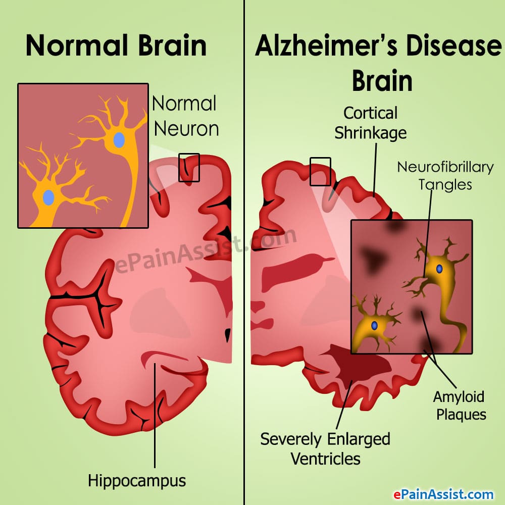 Alzheimerâs Disease