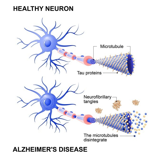 Alzheimers disease specific brain deposits photographed ...