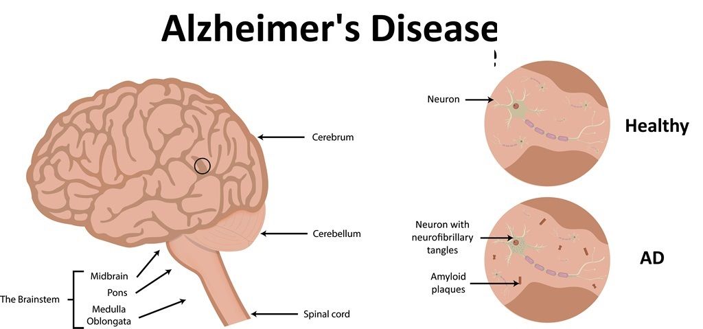 Alzheimers Disease  Symptoms, Causes &  Treatment of Alzheimers ...