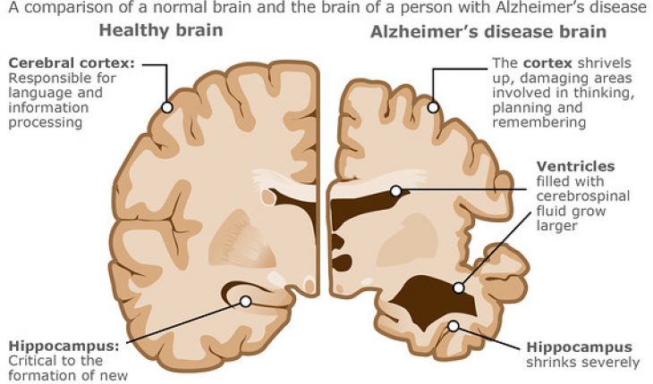 Alzheimers Disease: Symptoms, Stages &  Treatment » How To Relief
