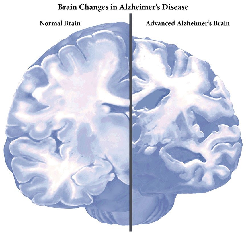 Alzheimers: Symptoms, Diagnosis, Treatment &  Care ...