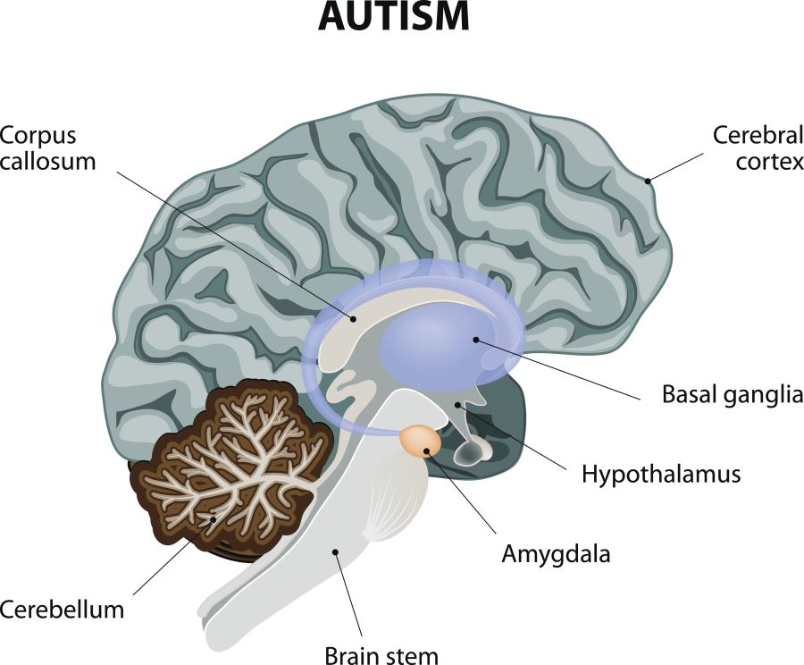 Amygdala Neurons Reduced in Adults With Autism