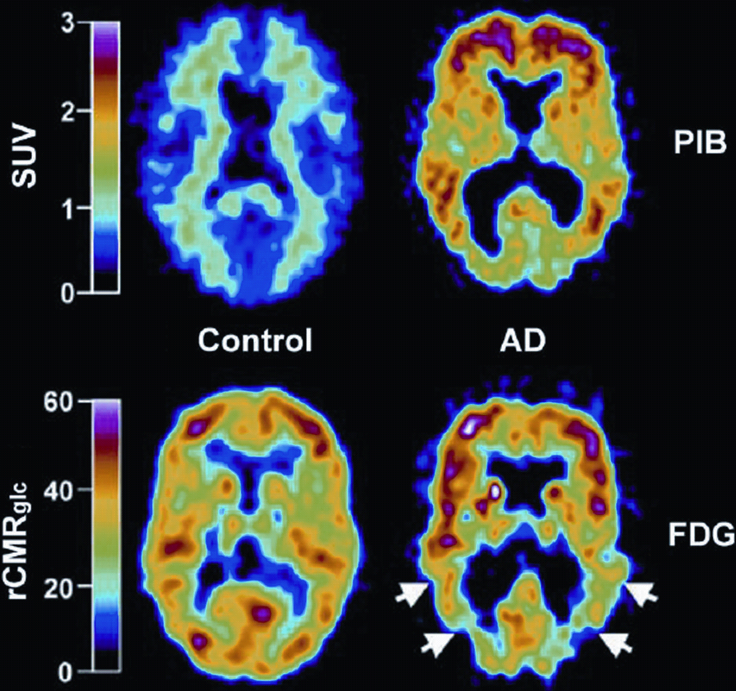 Amyloid Imaging with PET in Alzheimerâs Disease, Mild Cognitive ...