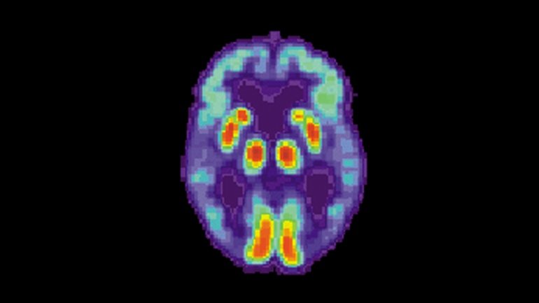 Artificial Intelligence Can Detect Alzheimers Disease in ...