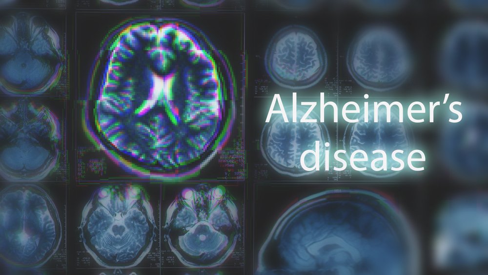 Bilingualism And Alzheimers Disease