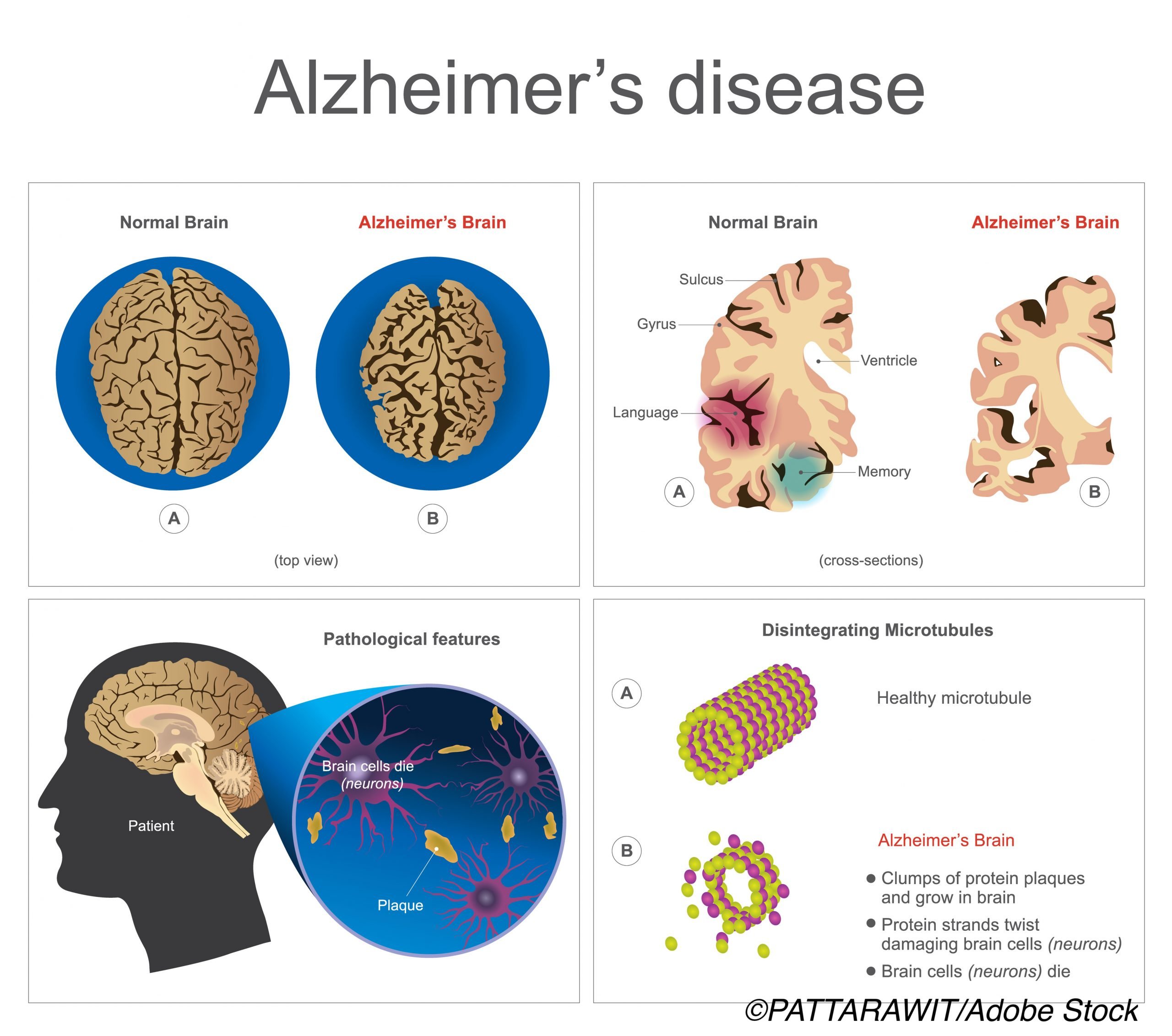 Biomarker Definition of Alzheimers Not Ready for Everyday Use ...