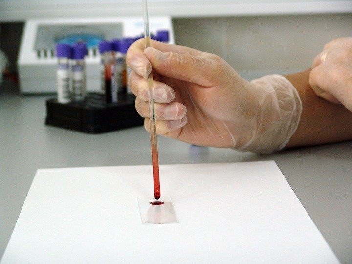 Blood Test That Can Detect Alzheimers Disease Now ...