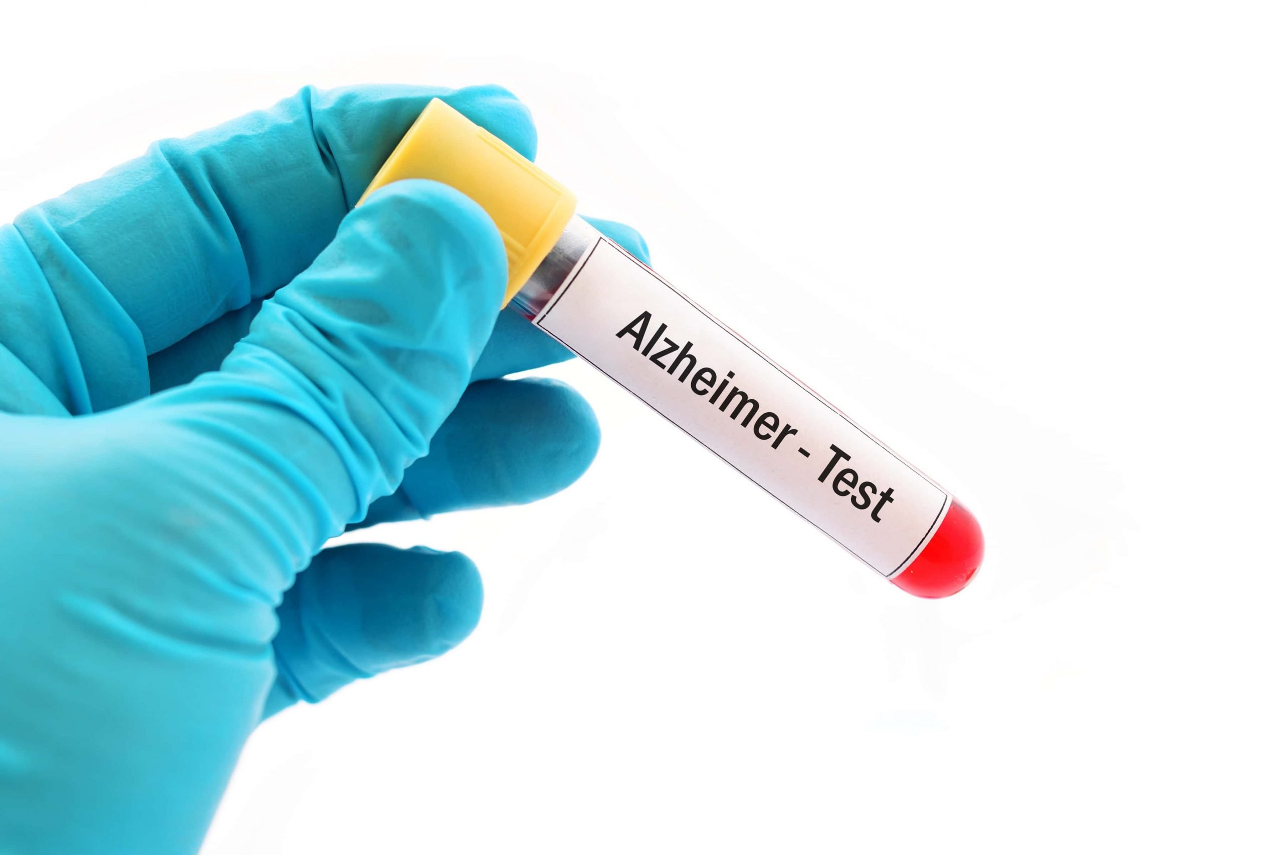 Blood test to detect Alzheimers years before the symptoms ...