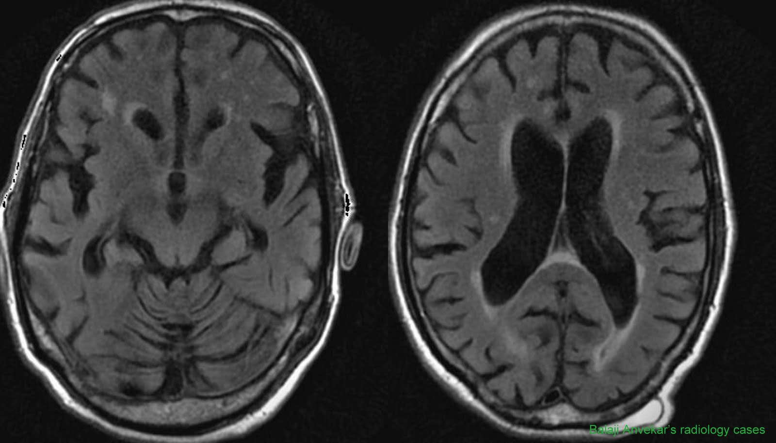 Brain Bleed: Brain Bleed And Dementia
