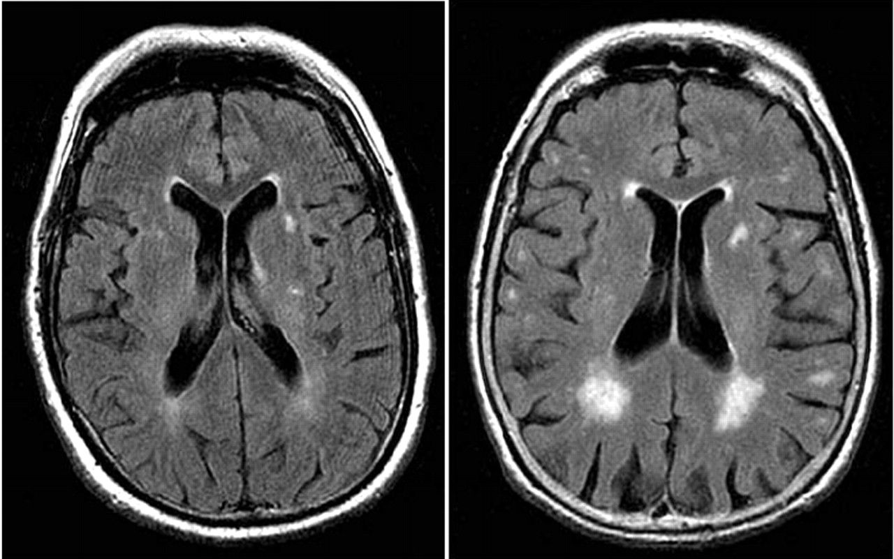 brain images of vascular dementia