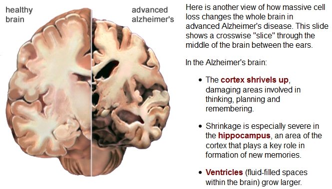 Caffeine use avoids the onset of Alzheimer