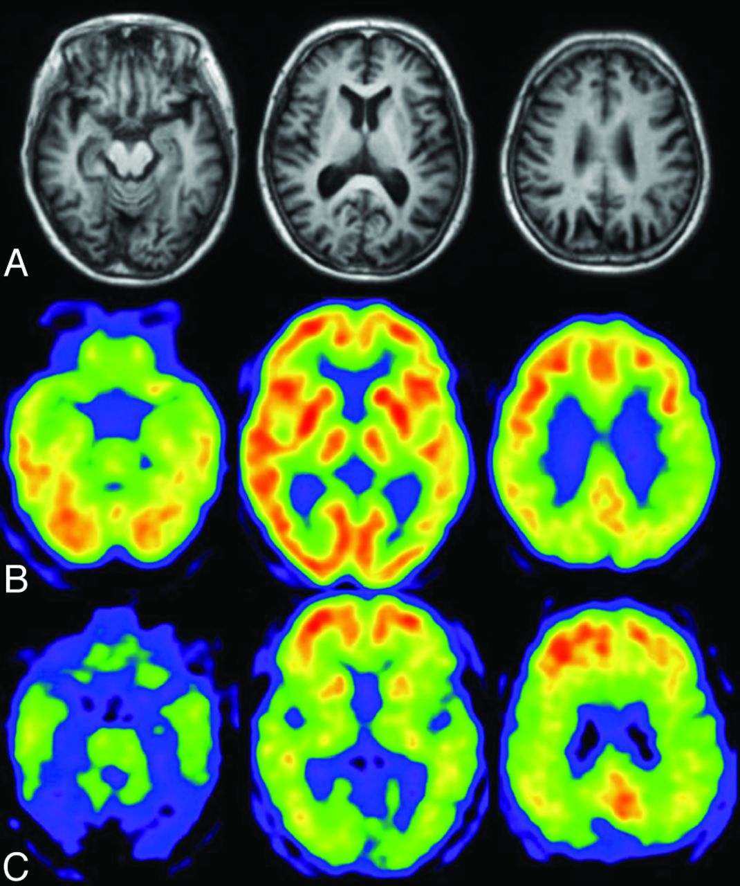 Can A Head Ct Scan Show Dementia