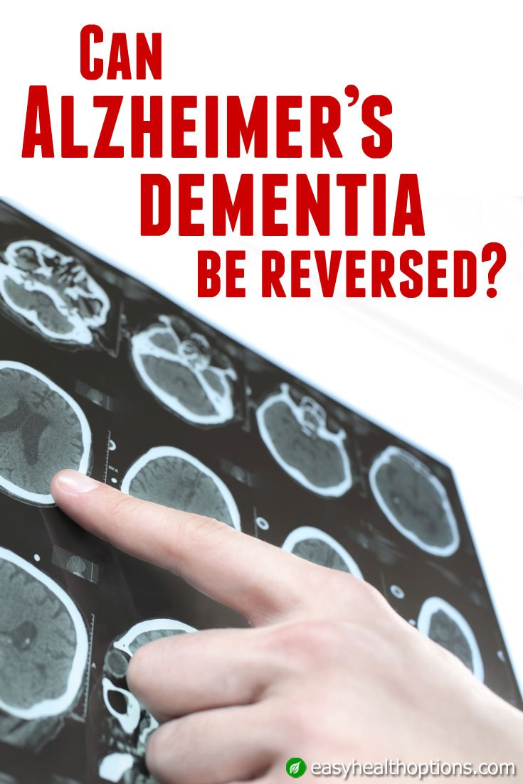 Can Alzheimer