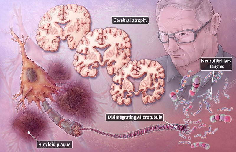 Characteristics Of Alzheimer