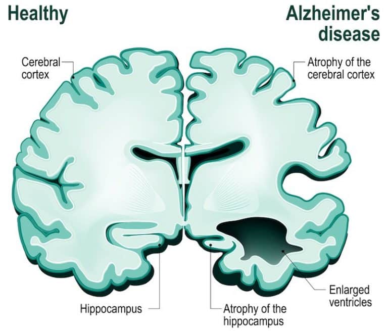 Clinical Trials in Alzheimer