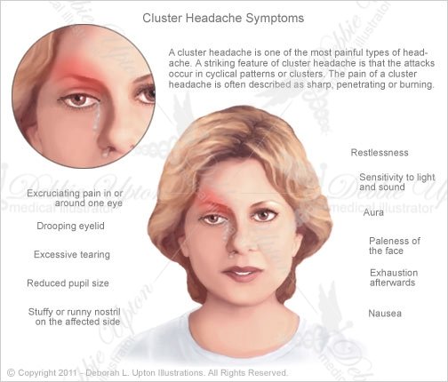 Cluster Headache. Causes, symptoms, treatment Cluster Headache