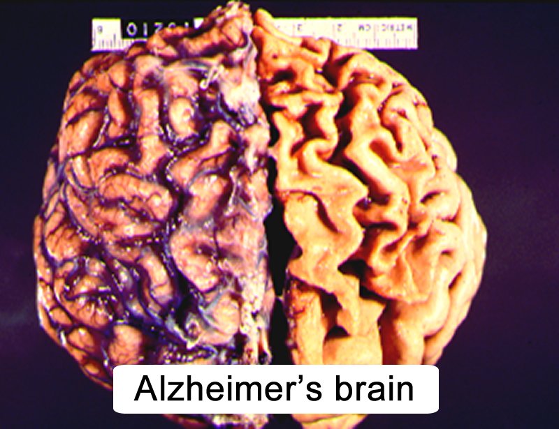 CNS Aging and Alzheimer