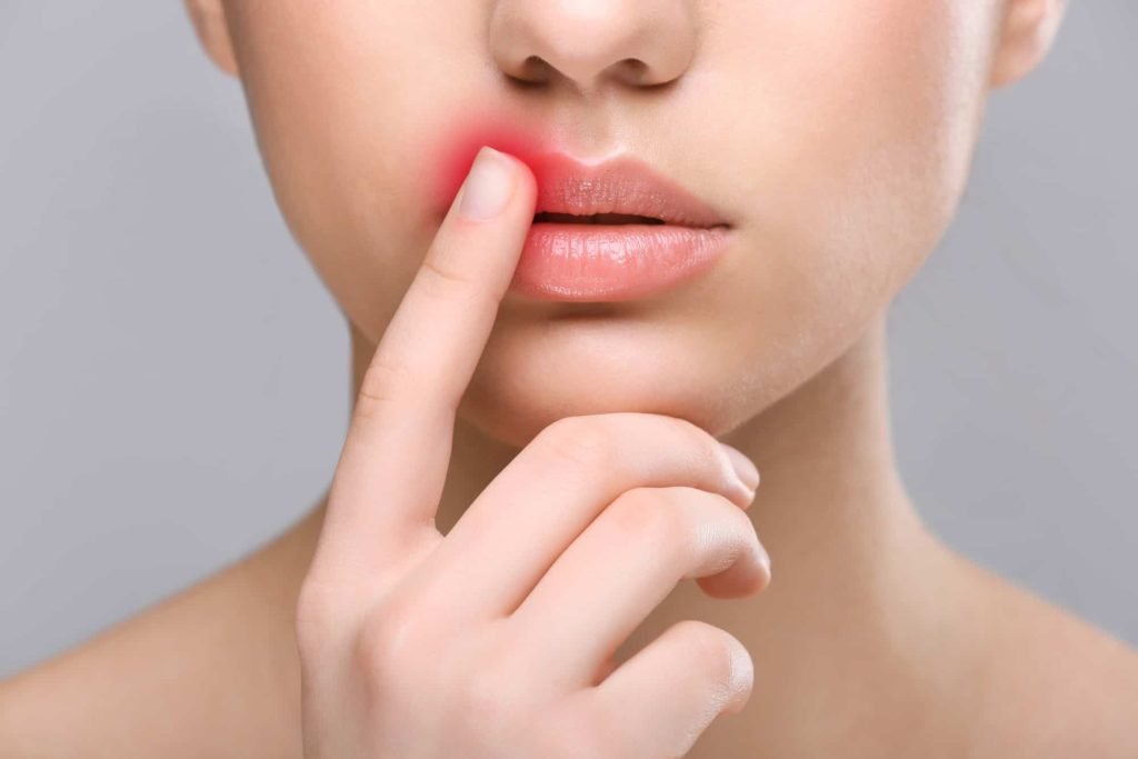 Cold Sores: Home Remedy That Works Fast