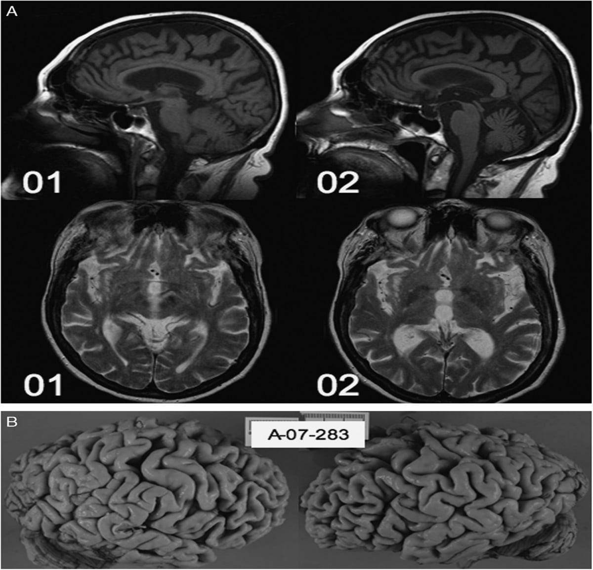 Delusions and Hallucinations in Frontotemporal Dementia: A C ...
