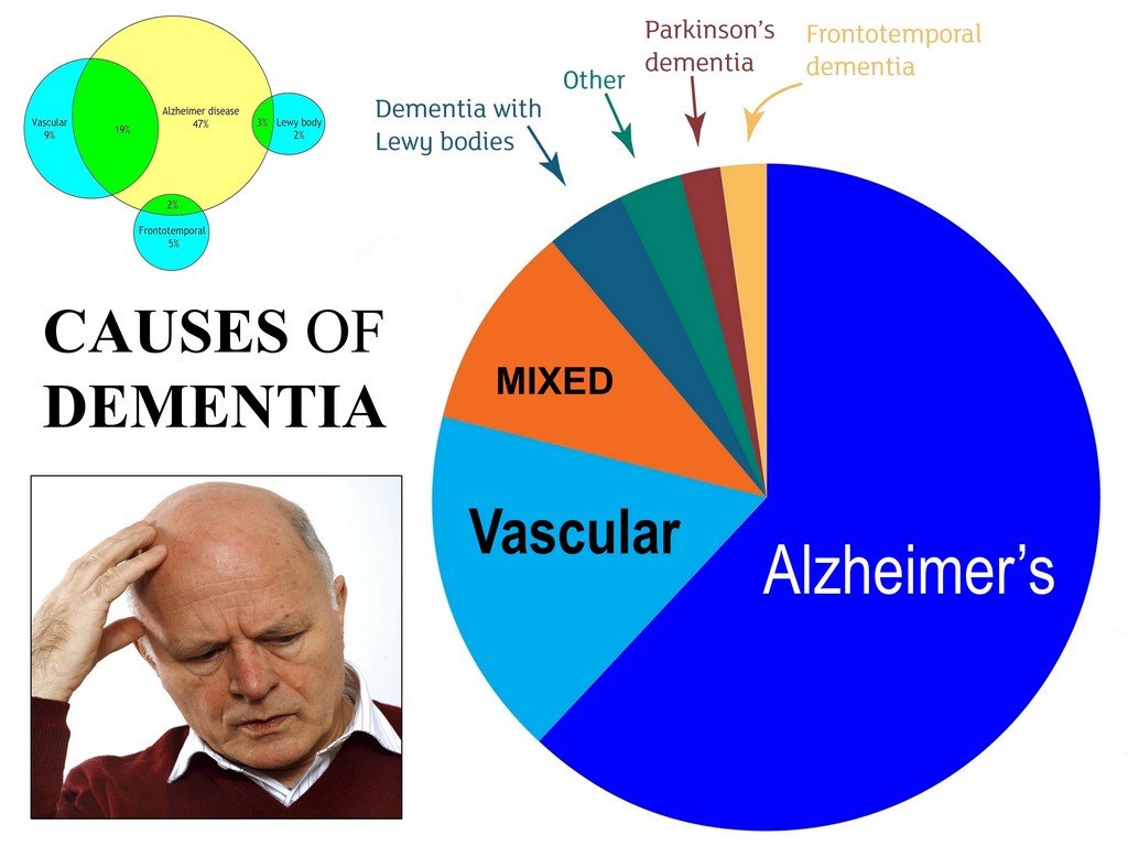 Dementia caused by Parkinson