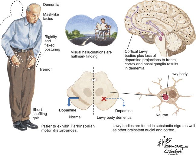 Dementia with Lewy Bodies (Including Parkinsons Disease ...