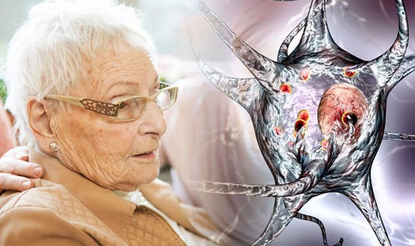 Dementia with Lewy Bodies symptoms: Six signs of the disease