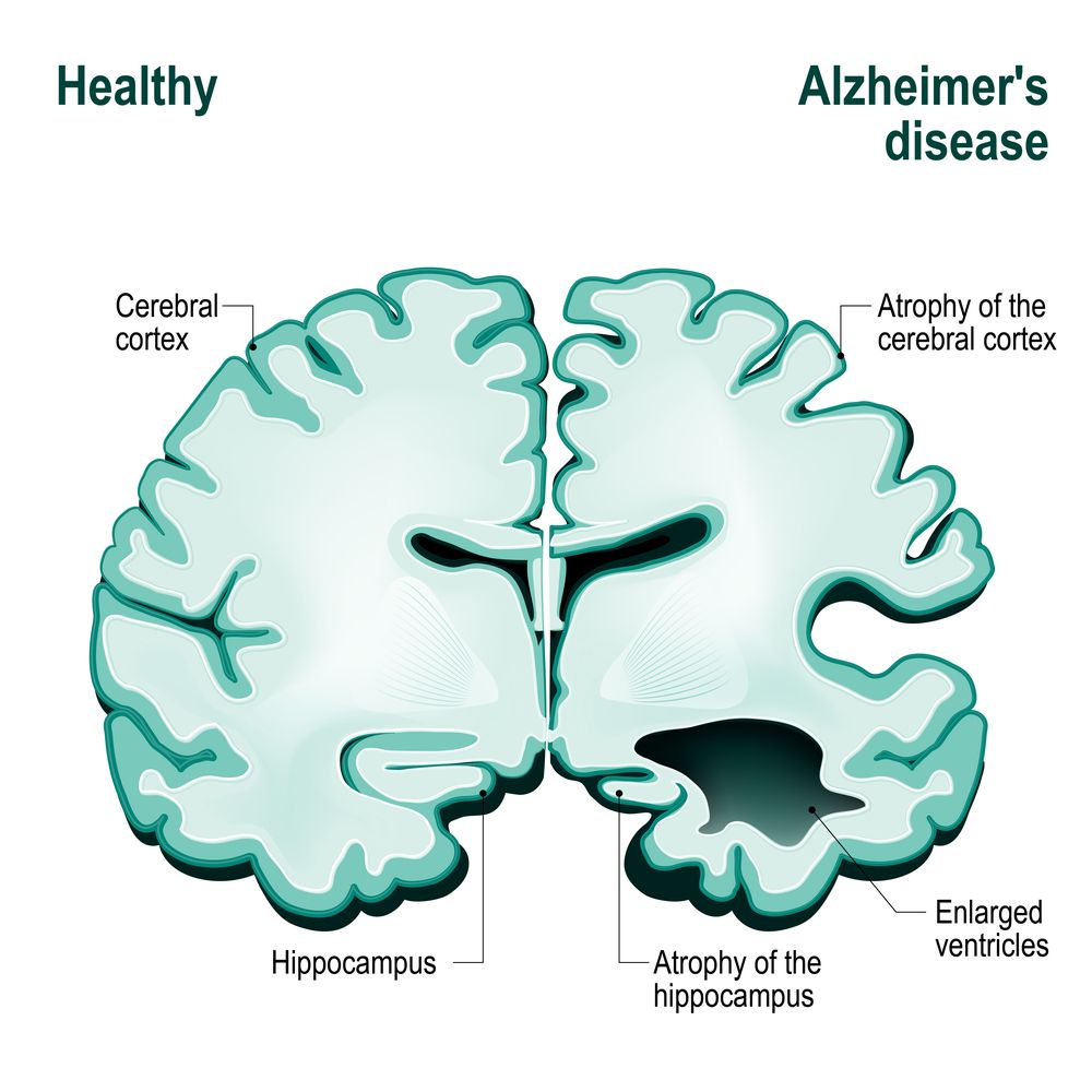 Determining If a Parent has Alzheimer