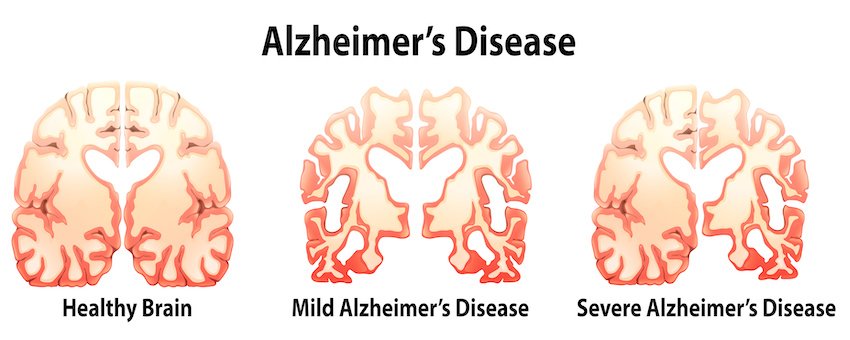Difference Between Dementia and Alzheimers