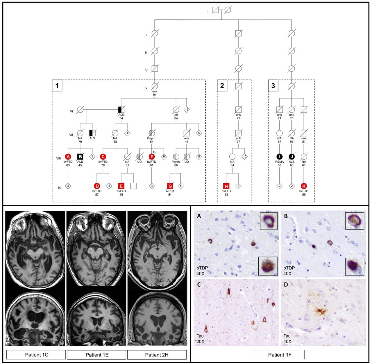 Distinctive pattern of temporal atrophy in patients with frontotemporal ...