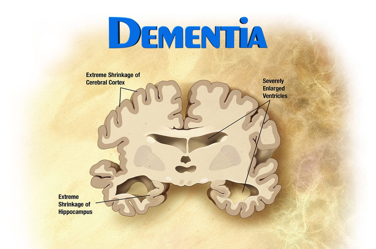 Distinguishing Alzheimerâs Disease from Other Types of ...