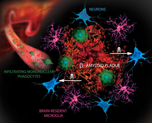 Does Abnormal Amyloid Cause Alzheimers