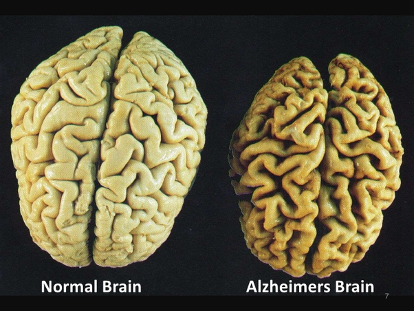 Does dementia shrink the brain?