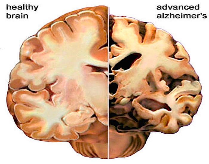 Does Fungus Cause Alzheimers Disease?
