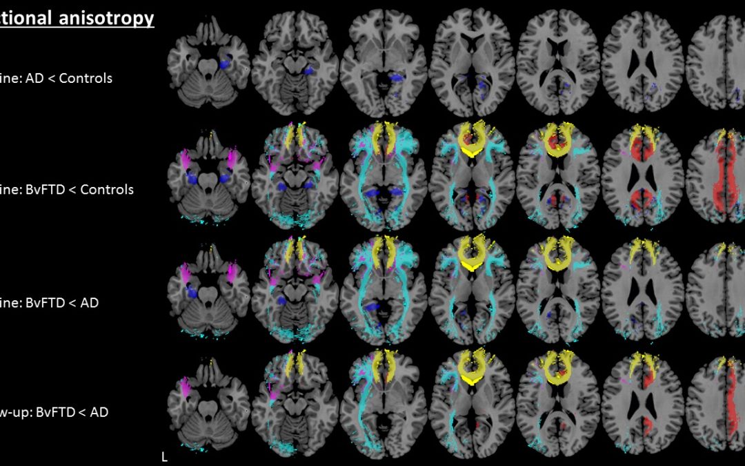 Early diagnosis of dementia with MRI