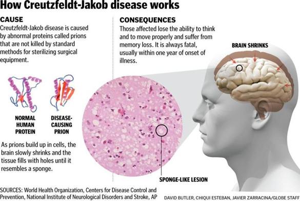 Eight patients possibly exposed to fatal brain disease ...
