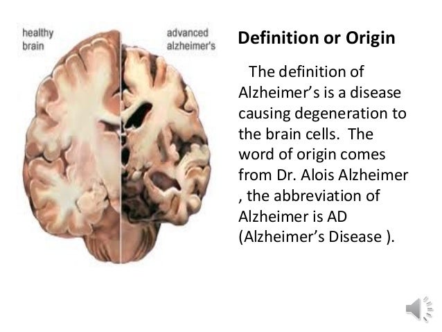 Factual report alzheimers disease