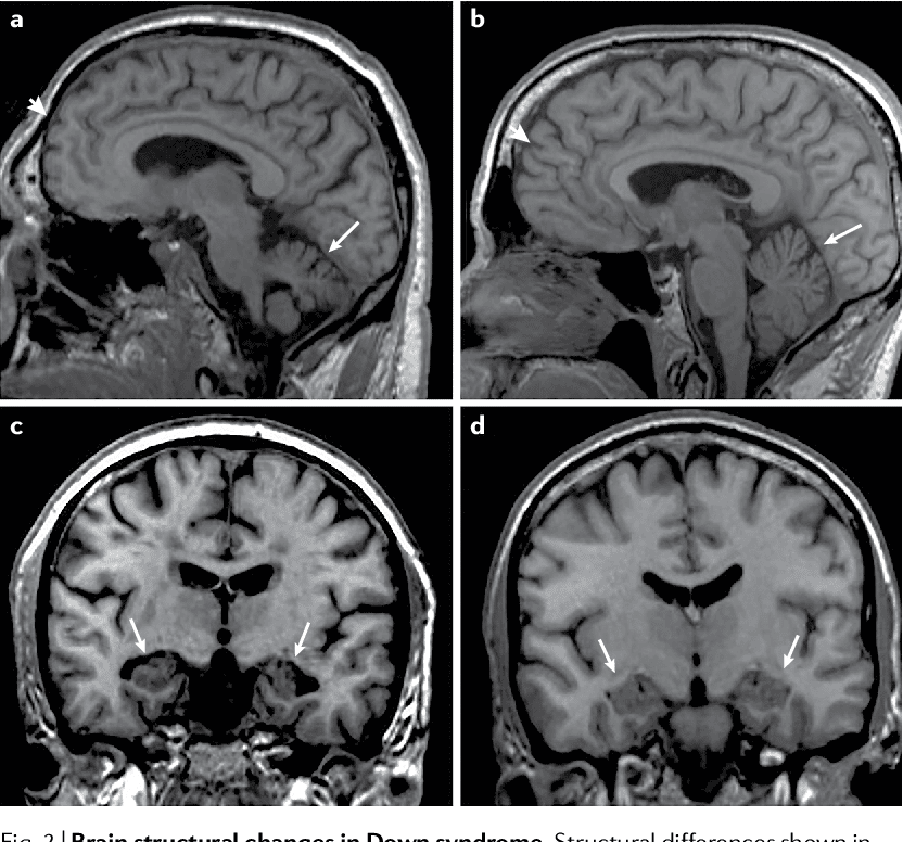 Figure 2 from Dementia in Down syndrome: unique insights for Alzheimer ...
