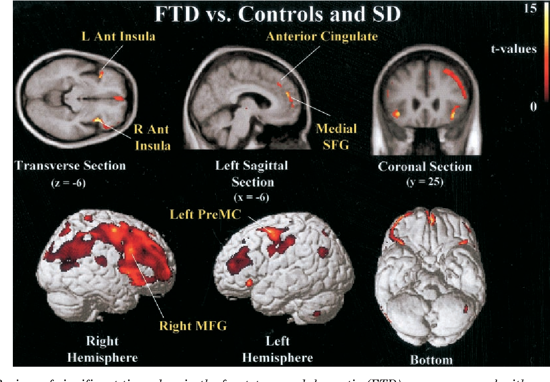 Figure 3 from Patterns of brain atrophy in frontotemporal dementia and ...