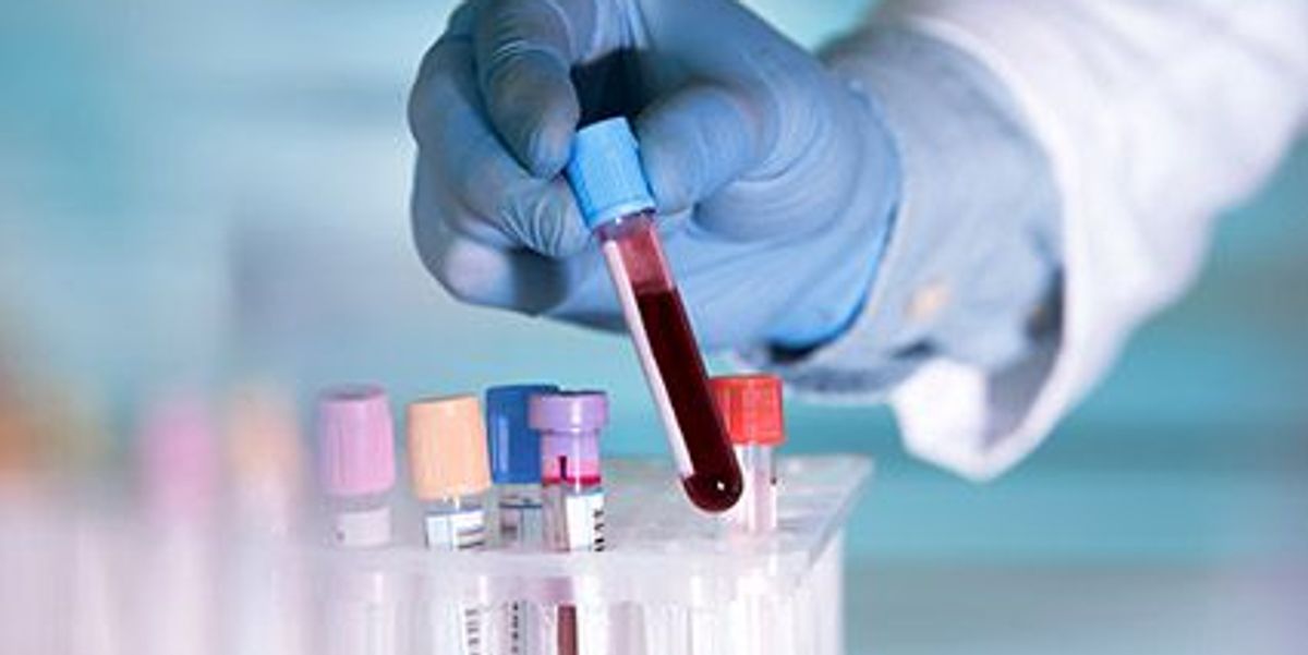 First Blood Test for Alzheimer Disease Available in U.S ...