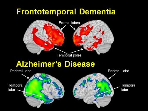 Frontal Lobe Dysfunction And Dementia
