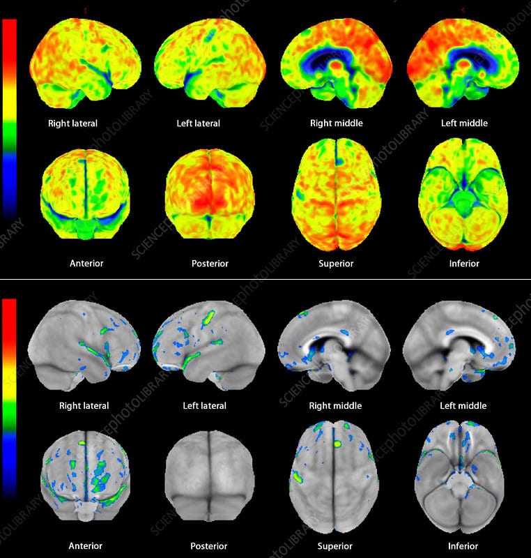 Frontotemporal dementia, 3D PET scans