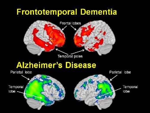 Frontotemporal Dementia (FTD) vs Alzheimer