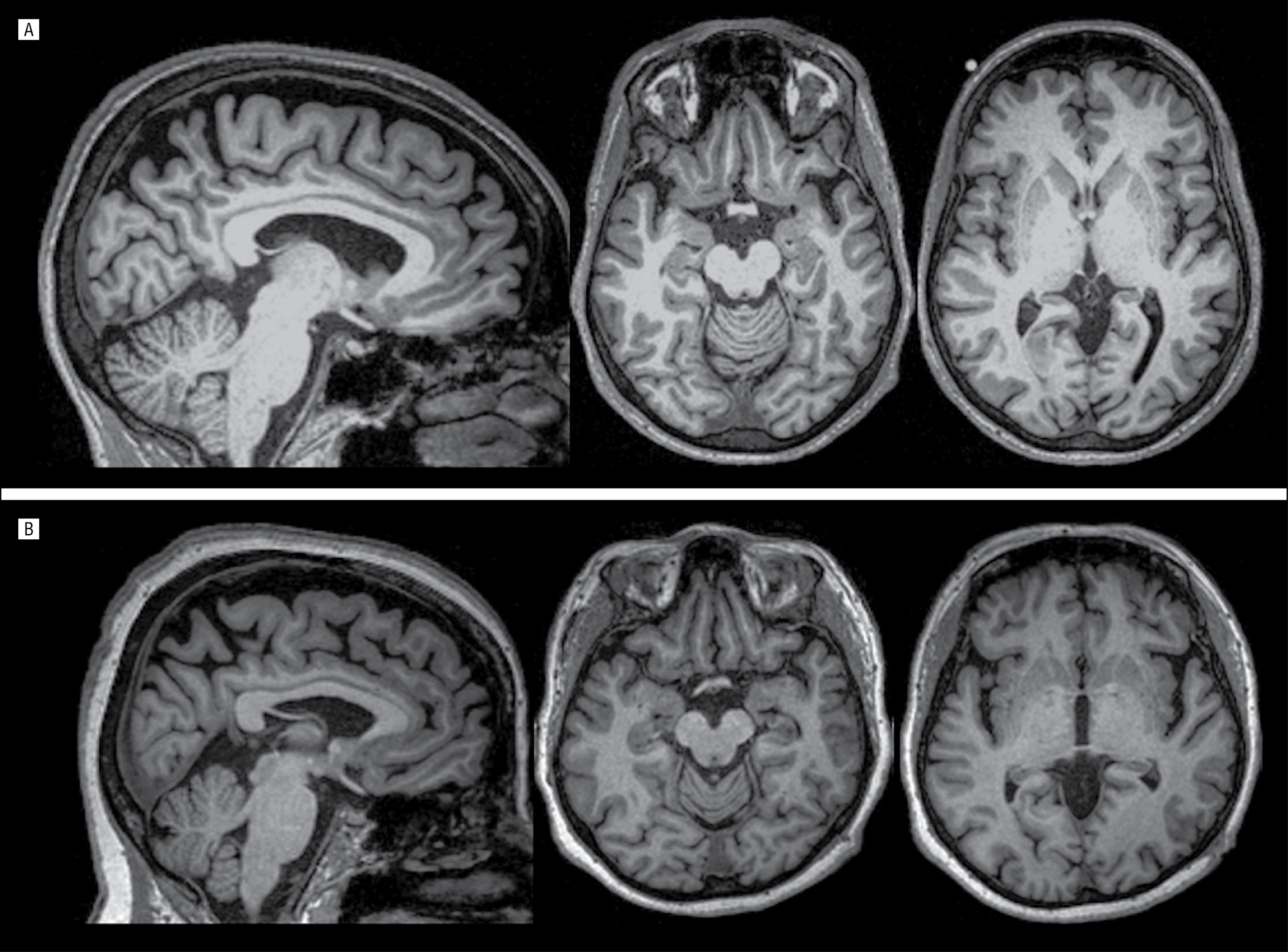 Frontotemporal Dementia in a Brazilian Kindred With the C9orf72 ...